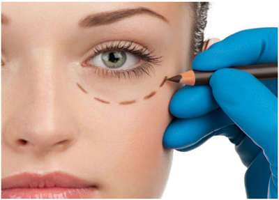 Blefaroplastia